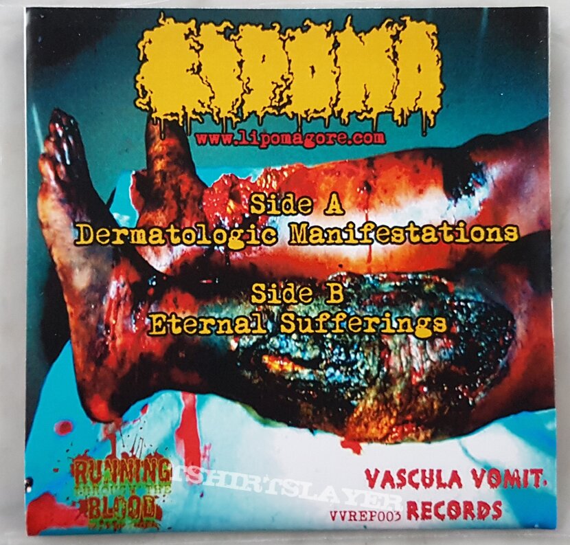 Lipoma Dermatologic manifestations // Eternal sufferings