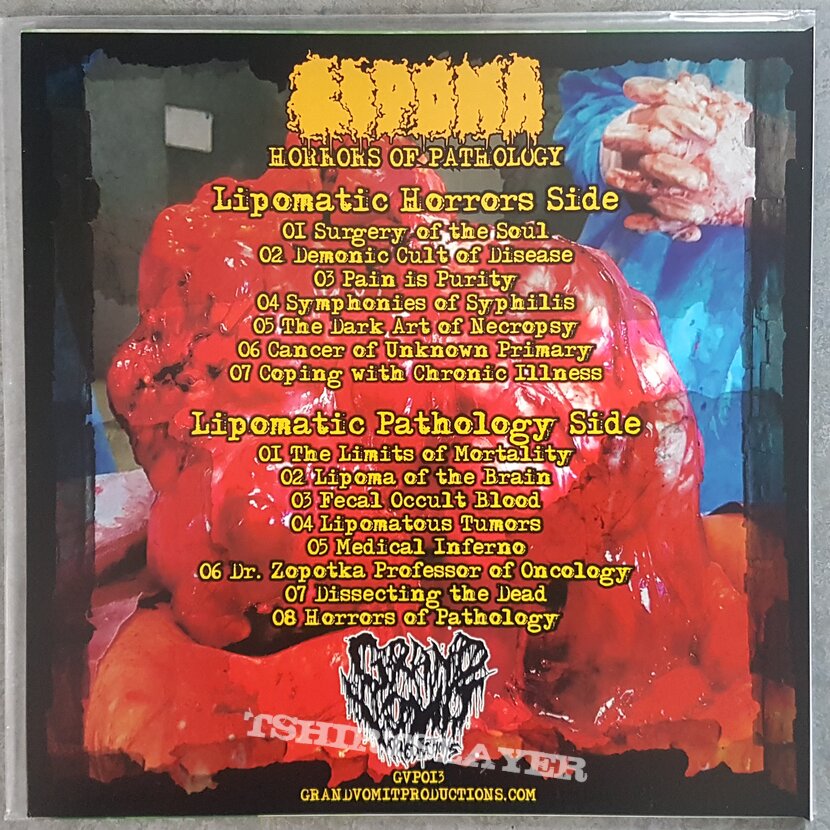 Lipoma Horrors of pathology 