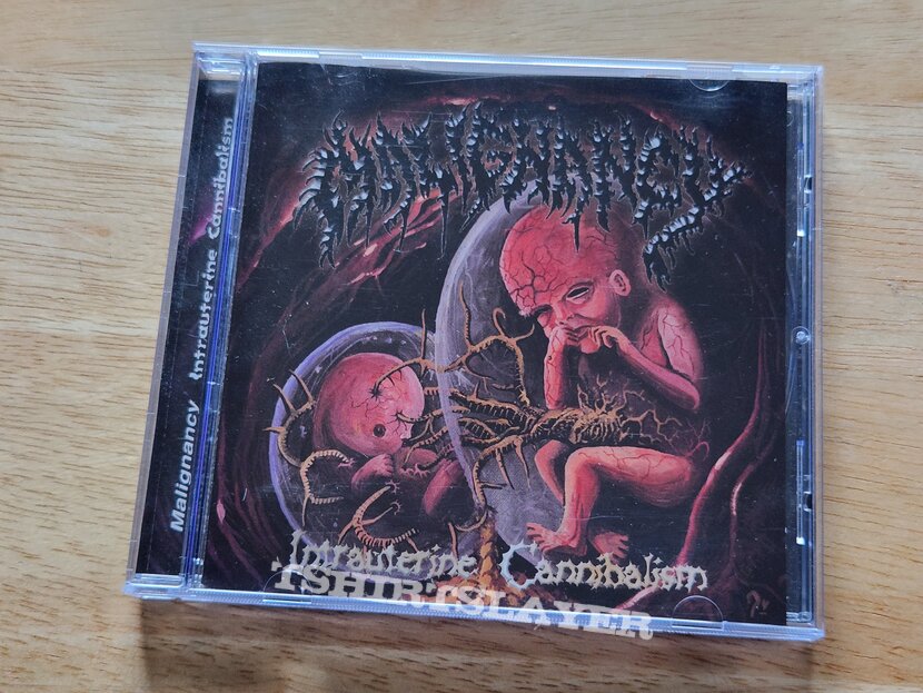 Malignancy - Intrauterine Cannibalism CD